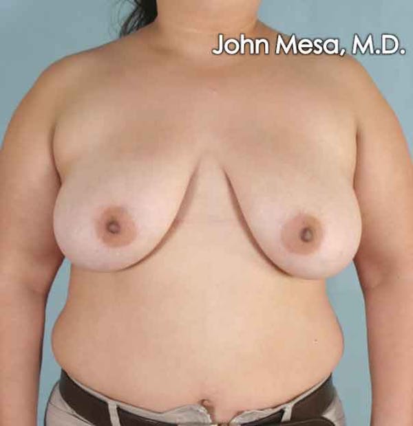 Breast Lift Before & After Gallery - Patient 6371451 - Image 1