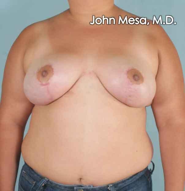 Breast Lift Gallery - Patient 6371451 - Image 2