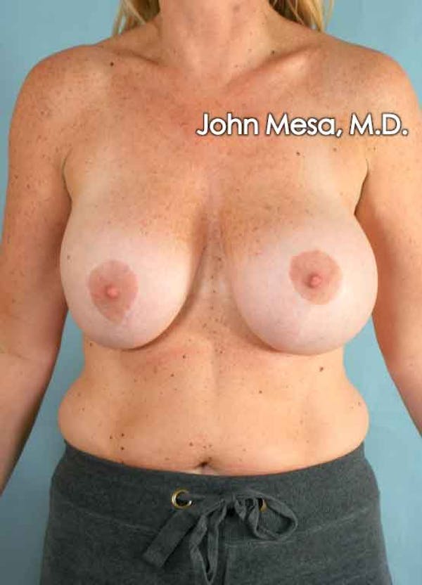 Breast Augmentation and Lift Before & After Gallery - Patient 6371457 - Image 1