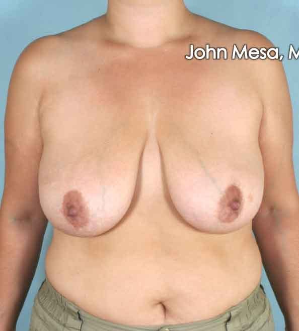 Breast Lift Before & After Gallery - Patient 6371458 - Image 1