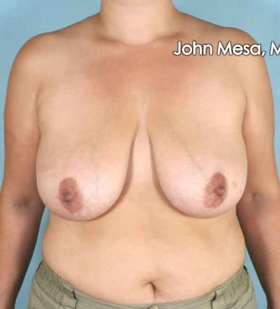 Breast Lift Before & After Gallery - Patient 6371458 - Image 1