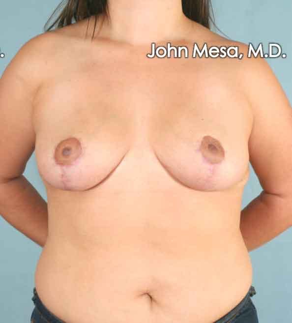 Breast Lift Gallery - Patient 6371458 - Image 2
