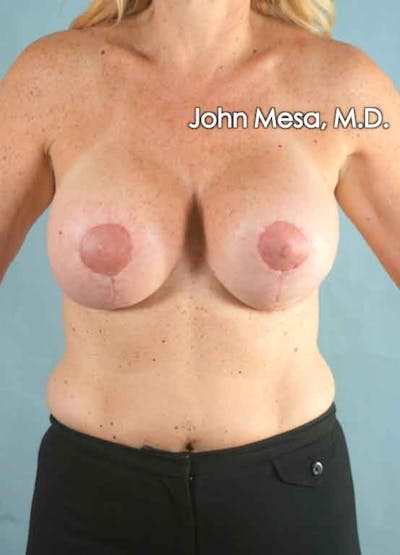 Breast Augmentation and Lift Before & After Gallery - Patient 6371457 - Image 2