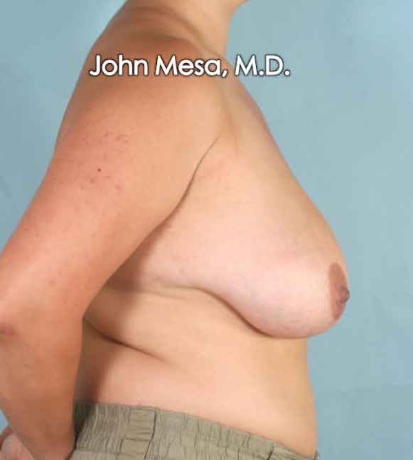 Breast Lift Before & After Gallery - Patient 6371458 - Image 3