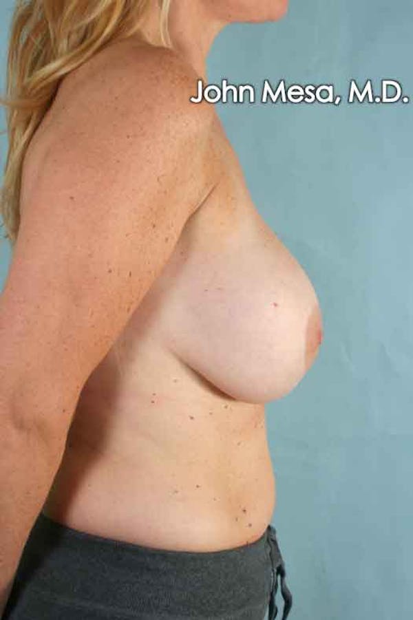 Breast Augmentation and Lift Before & After Gallery - Patient 6371457 - Image 3