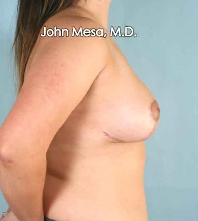 Breast Lift Before & After Gallery - Patient 6371458 - Image 4