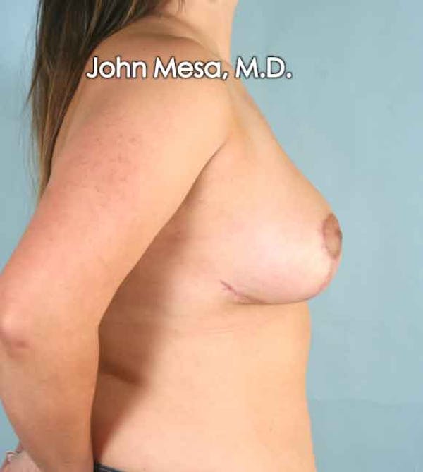 Breast Lift Before & After Gallery - Patient 6371458 - Image 4