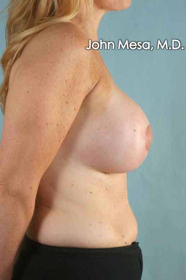Breast Augmentation and Lift Gallery - Patient 6371457 - Image 4