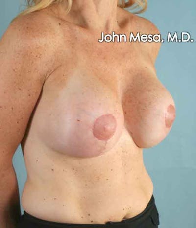 Breast Augmentation and Lift Gallery - Patient 6371457 - Image 6
