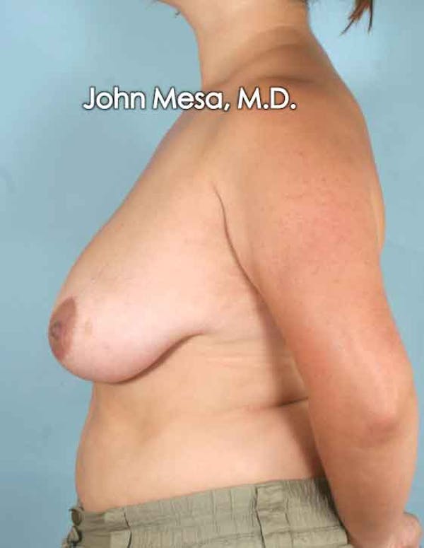 Breast Lift Before & After Gallery - Patient 6371458 - Image 7