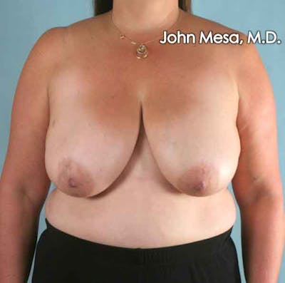 Breast Reduction Before & After Gallery - Patient 6371459 - Image 1