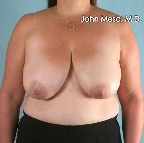 Breast Reduction Before & After Gallery - Patient 6371459 - Image 1