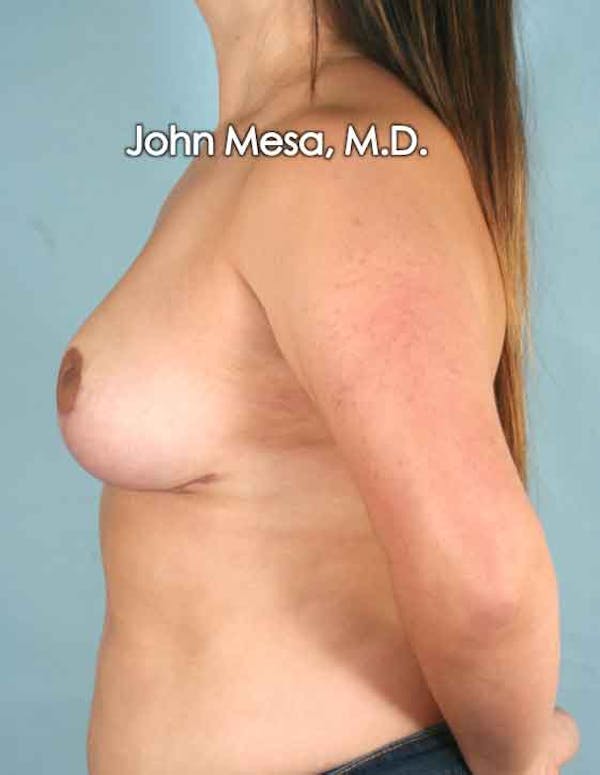 Breast Lift Before & After Gallery - Patient 6371458 - Image 8