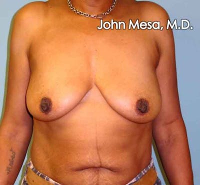 Breast Augmentation and Lift Gallery - Patient 6371460 - Image 1