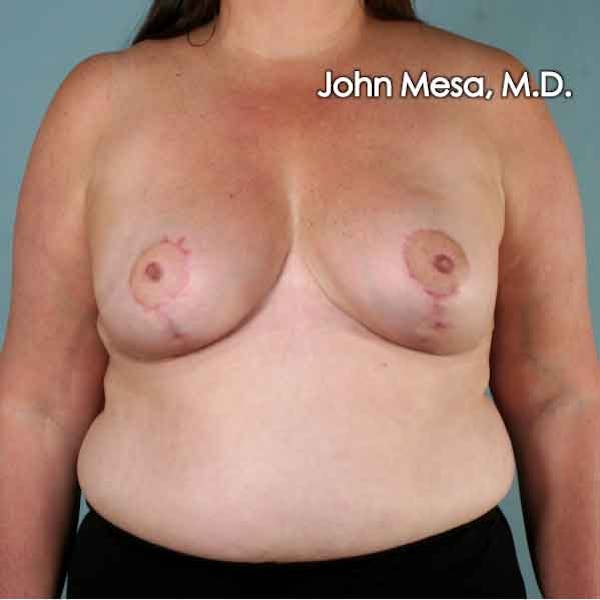 Breast Reduction Before & After Gallery - Patient 6371459 - Image 2