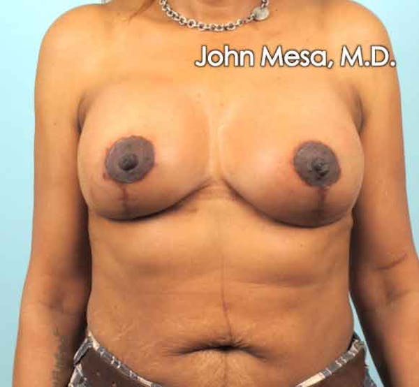 Breast Augmentation and Lift Gallery - Patient 6371460 - Image 2