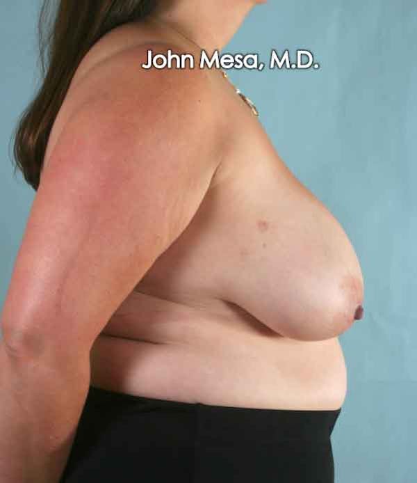 Breast Reduction Before & After Gallery - Patient 6371459 - Image 3