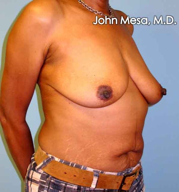 Breast Augmentation and Lift Before & After Gallery - Patient 6371460 - Image 3