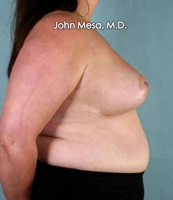 Breast Reduction Before & After Gallery - Patient 6371459 - Image 4