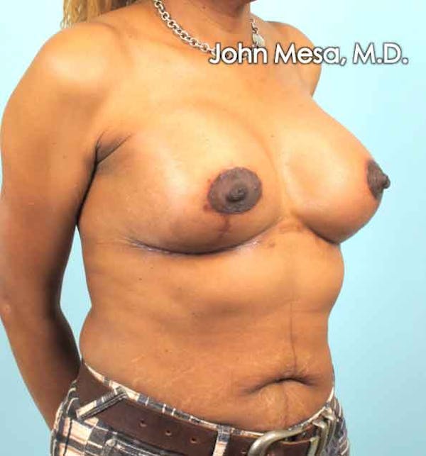 Breast Augmentation and Lift Before & After Gallery - Patient 6371460 - Image 4