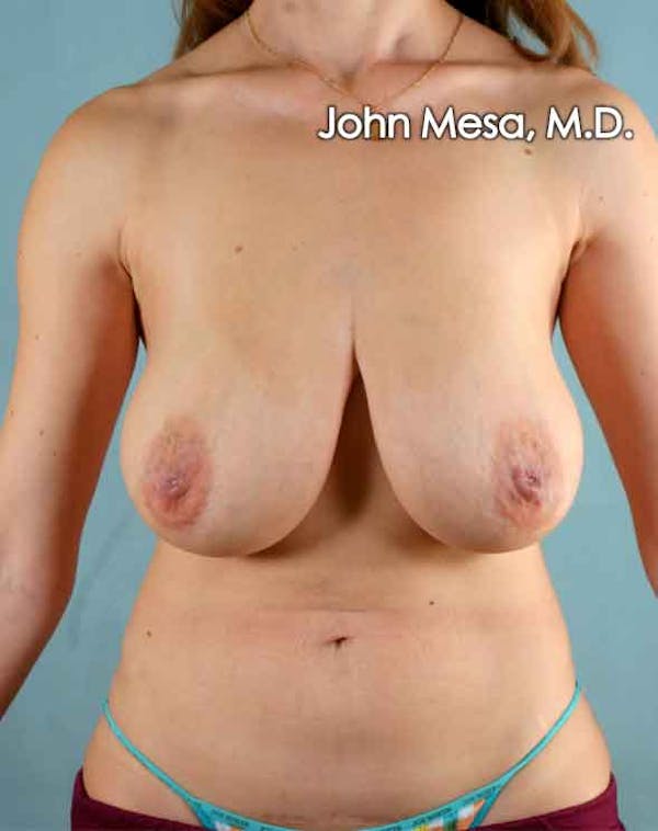 Breast Lift Gallery - Patient 6371461 - Image 1