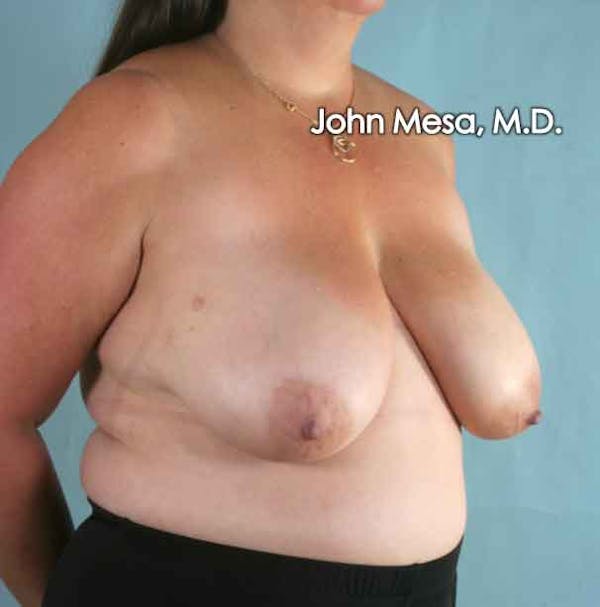 Breast Reduction Before & After Gallery - Patient 6371459 - Image 5