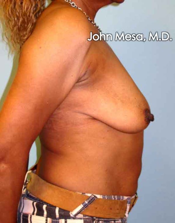 Breast Augmentation and Lift Before & After Gallery - Patient 6371460 - Image 5