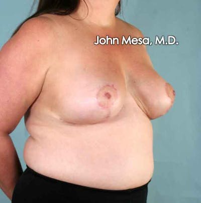 Breast Reduction Before & After Gallery - Patient 6371459 - Image 6