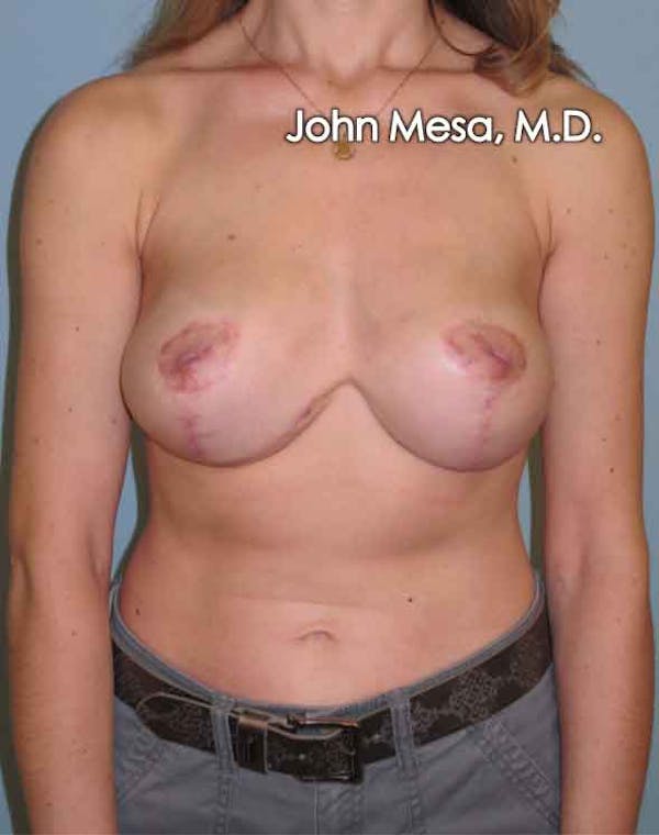 Breast Lift Before & After Gallery - Patient 6371461 - Image 2
