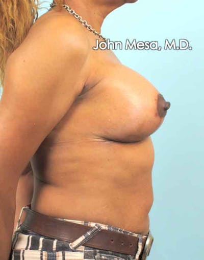 Breast Augmentation and Lift Before & After Gallery - Patient 6371460 - Image 6