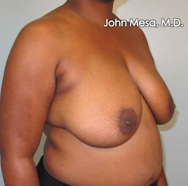 Breast Reduction Before & After Gallery - Patient 6371462 - Image 1