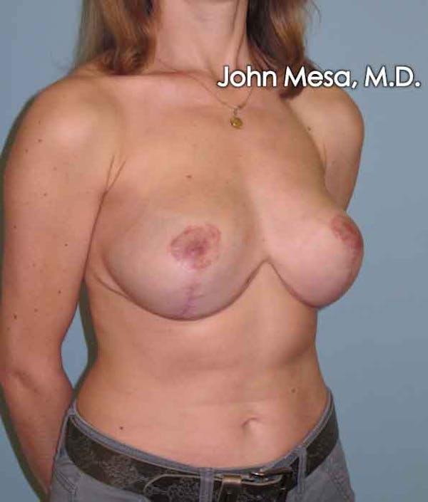 Breast Lift Before & After Gallery - Patient 6371461 - Image 4
