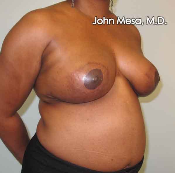 Breast Reduction Before & After Gallery - Patient 6371462 - Image 2