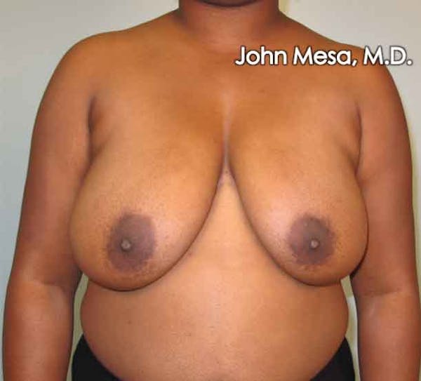 Breast Reduction Before & After Gallery - Patient 6371462 - Image 3