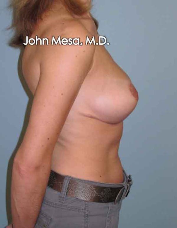 Breast Lift Before & After Gallery - Patient 6371461 - Image 6