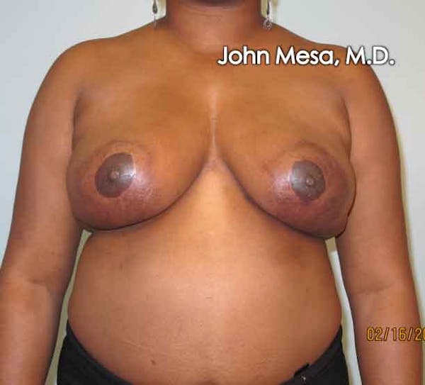 Breast Reduction Before & After Gallery - Patient 6371462 - Image 4