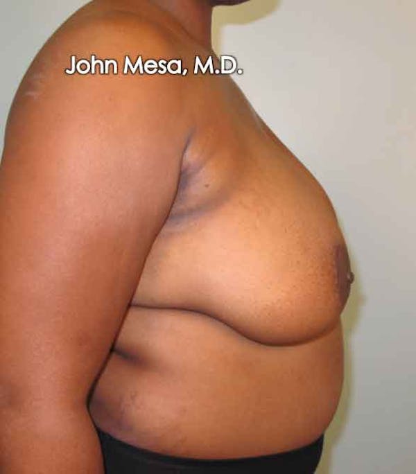 Breast Reduction Before & After Gallery - Patient 6371462 - Image 5