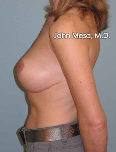 Breast Lift Before & After Gallery - Patient 6371461 - Image 8