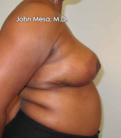 Breast Reduction Before & After Gallery - Patient 6371462 - Image 6