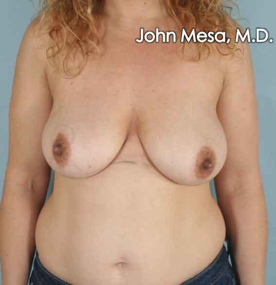 Breast Lift Before & After Gallery - Patient 6371464 - Image 1