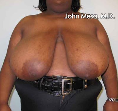 Breast Reduction Before & After Gallery - Patient 6371463 - Image 1