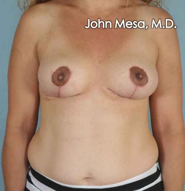 Breast Lift Before & After Gallery - Patient 6371464 - Image 2