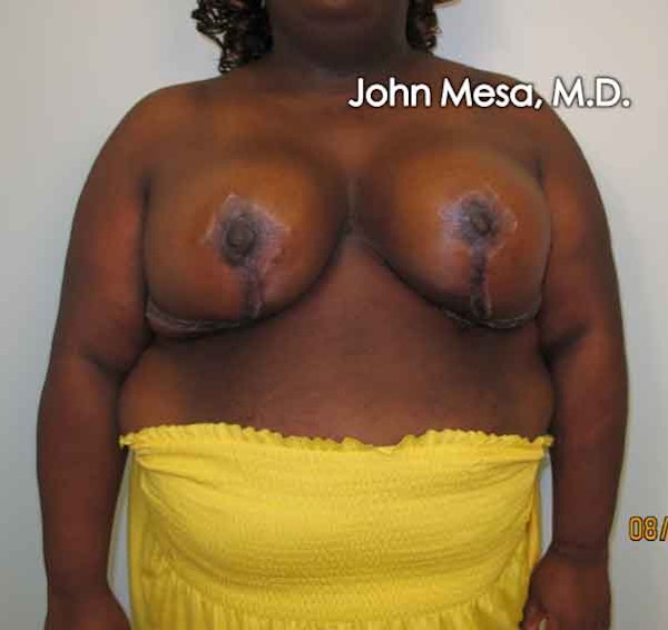 Breast Reduction