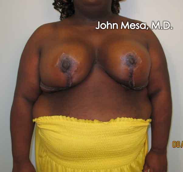 Breast Reduction Before & After Gallery - Patient 6371463 - Image 2