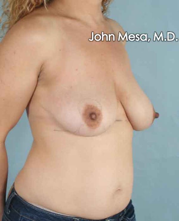 Breast Lift Before & After Gallery - Patient 6371464 - Image 3