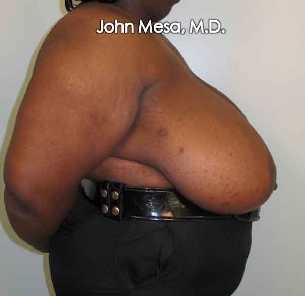Breast Reduction Before & After Gallery - Patient 6371463 - Image 3