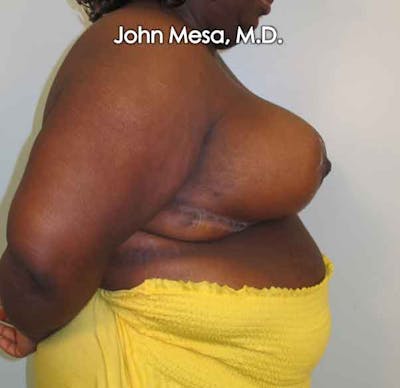Breast Reduction Before & After Gallery - Patient 6371463 - Image 4