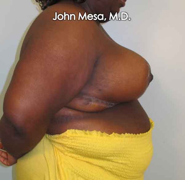 Breast Reduction Before & After Gallery - Patient 6371463 - Image 4