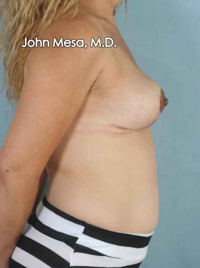 Breast Lift Before & After Gallery - Patient 6371464 - Image 6