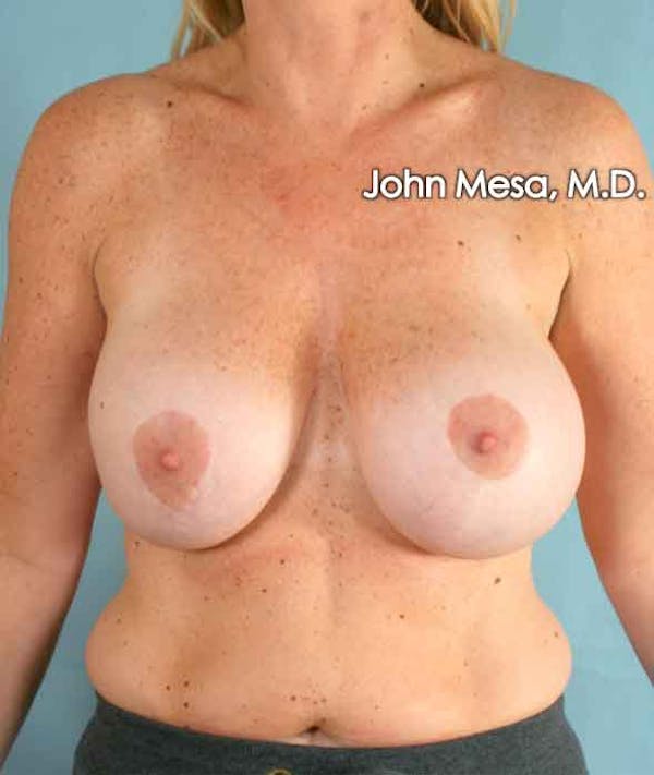 Breast Surgery Revision Gallery - Patient 6371485 - Image 1